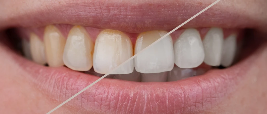 Éclaircissement dentaire 