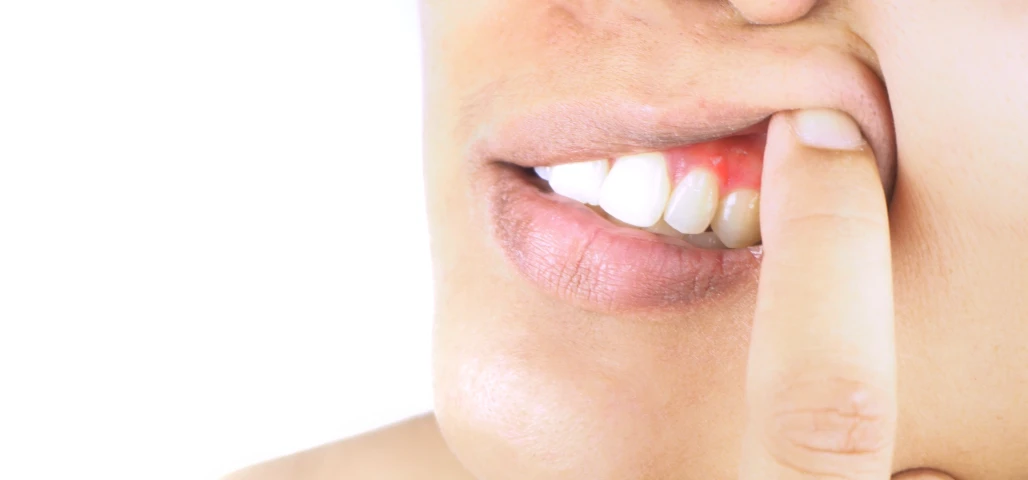 Traitement des gencives 