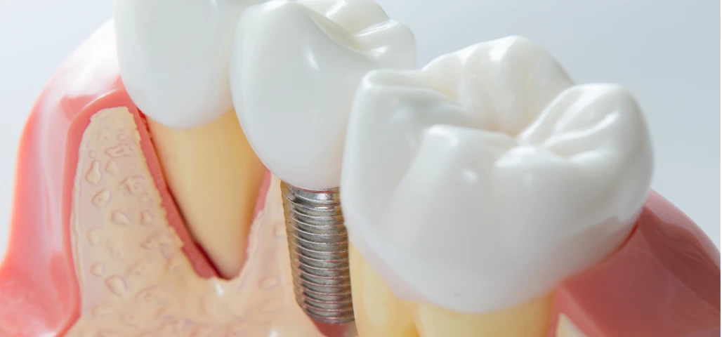 Implant dentaire unitaire 