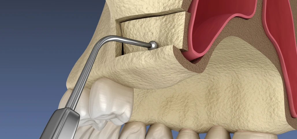 Comblement de sinus / Sinus lift 