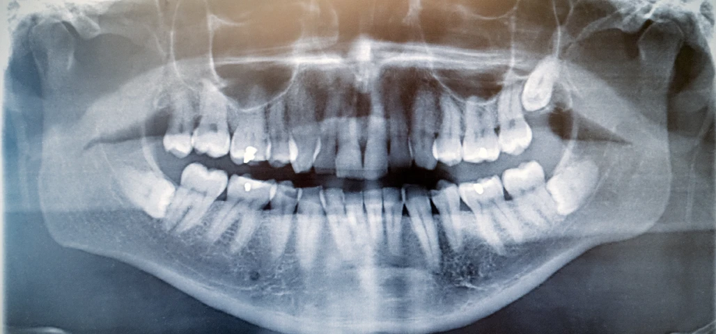 Extraction des dents de sagesse 