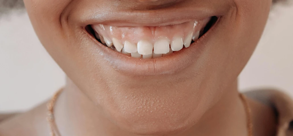 Alignement des collets dentaires 