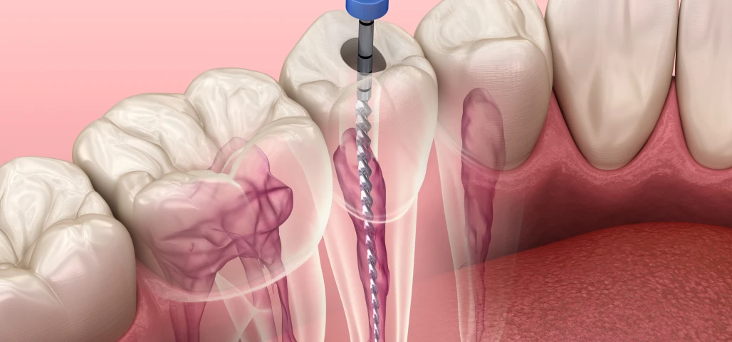 Le traitement endodontique 