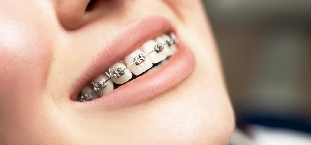 Le traitement appareils dentaires métalliques