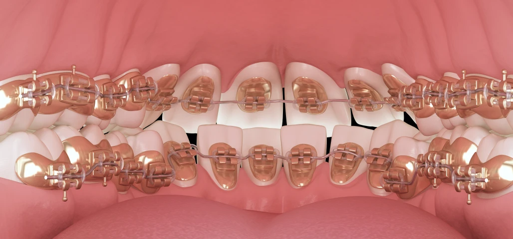 Le traitement par appareil dentaire lingual